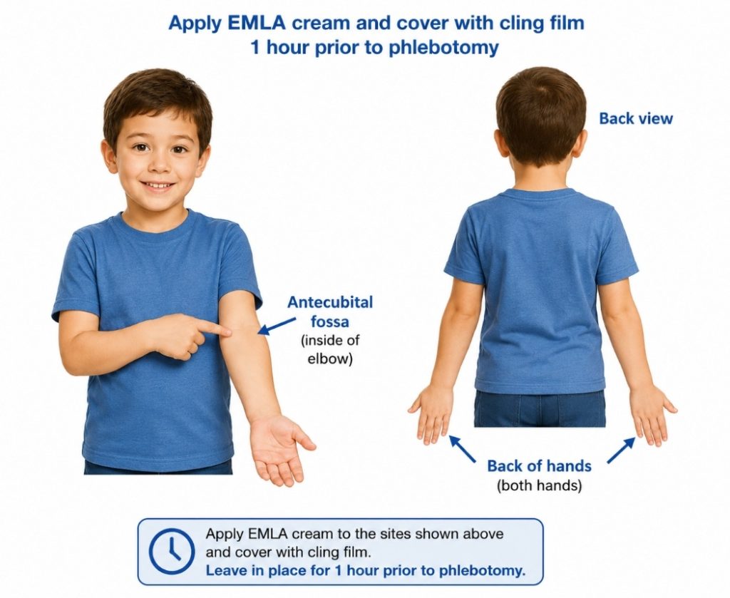 A diagram of the proper application locations and practice for paediatric phlebotomy. The words "Apply EMLA cream and cover with cling film 1 hour prior to phlebotomy" are at the top. There is an image of a small child pointing to the inside of their elbow (a.k.a the Antecubital fossa). Next to that is the image of the same child with their back to the viewer, arms outstretched by their sides, with arrows pointing to the back of both hands. Beneath these images is a blue box with a clock face and the words "Apply EMLA cream to the sites shown above and cover with cling film. Leave in place for 1 hour prior to phlebotomy."